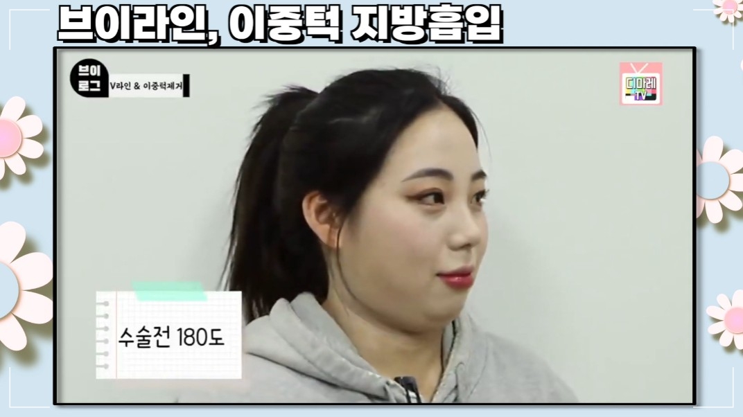 턱살빼기 디마레클리닉
