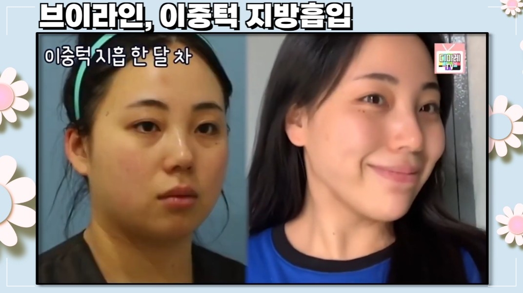 얼굴지방흡입 브이라인, 이중턱 지방흡입 턱살빼기 전후 사진