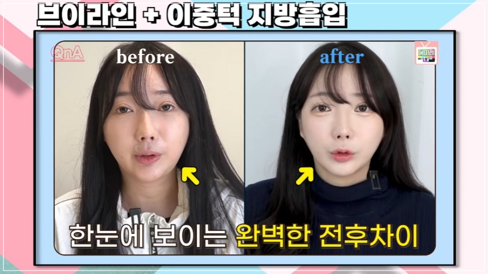 디마레클리닉 얼굴 지방흡입 4개월 후 변화