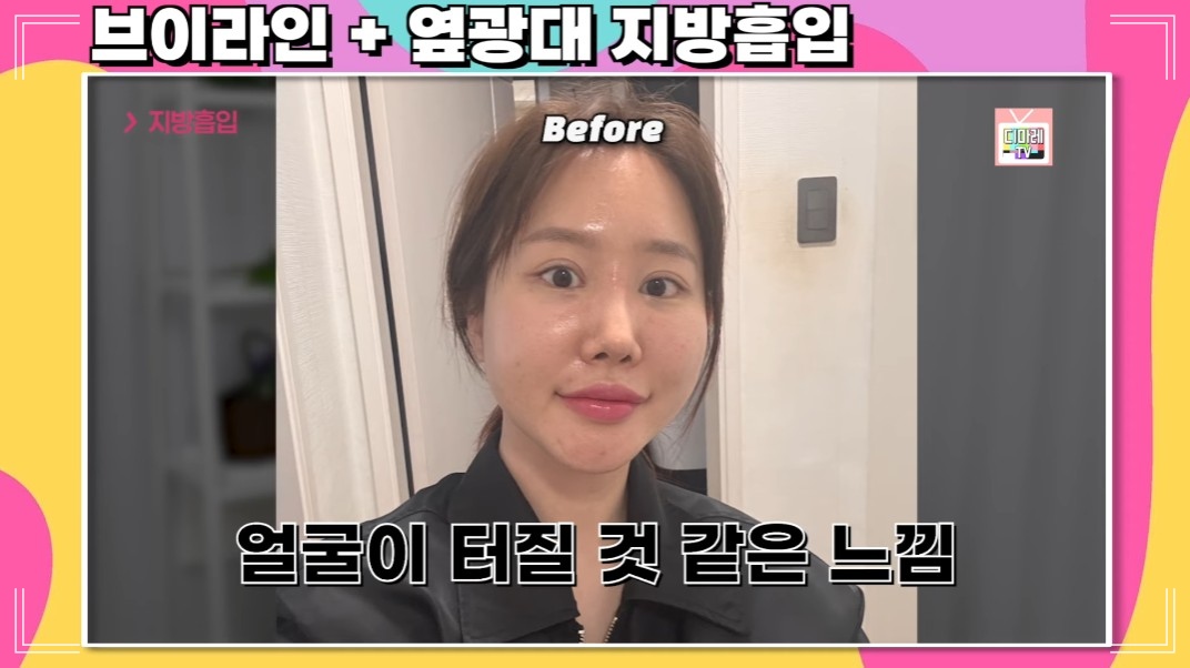 턱살 시술 전