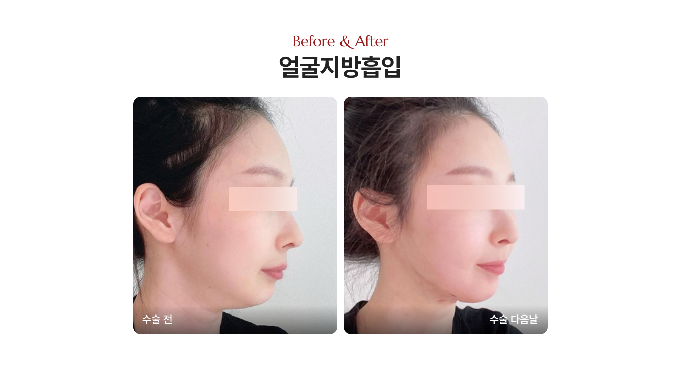 얼굴 살 빼는 법 전후사진