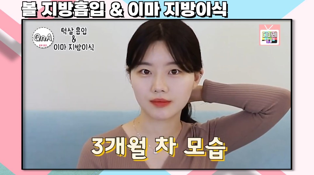 디마레클리닉 얼굴지방흡입 3개월 후 변화