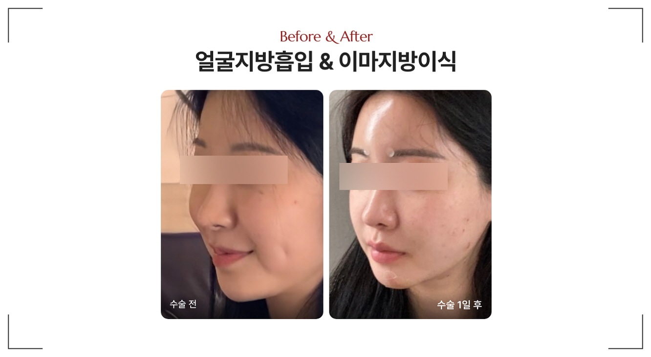 얼굴지방흡입가격과 함께 보는 전후사진
