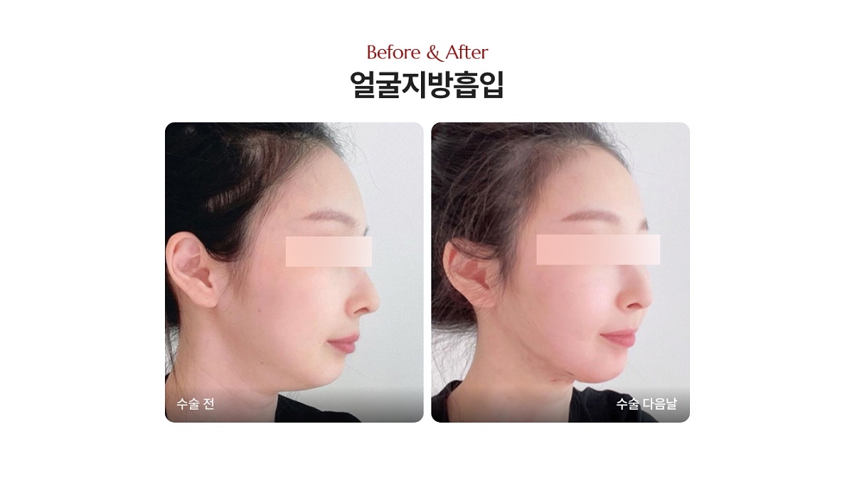 얼굴지방흡입 붓기 전후 비교 후기 사진