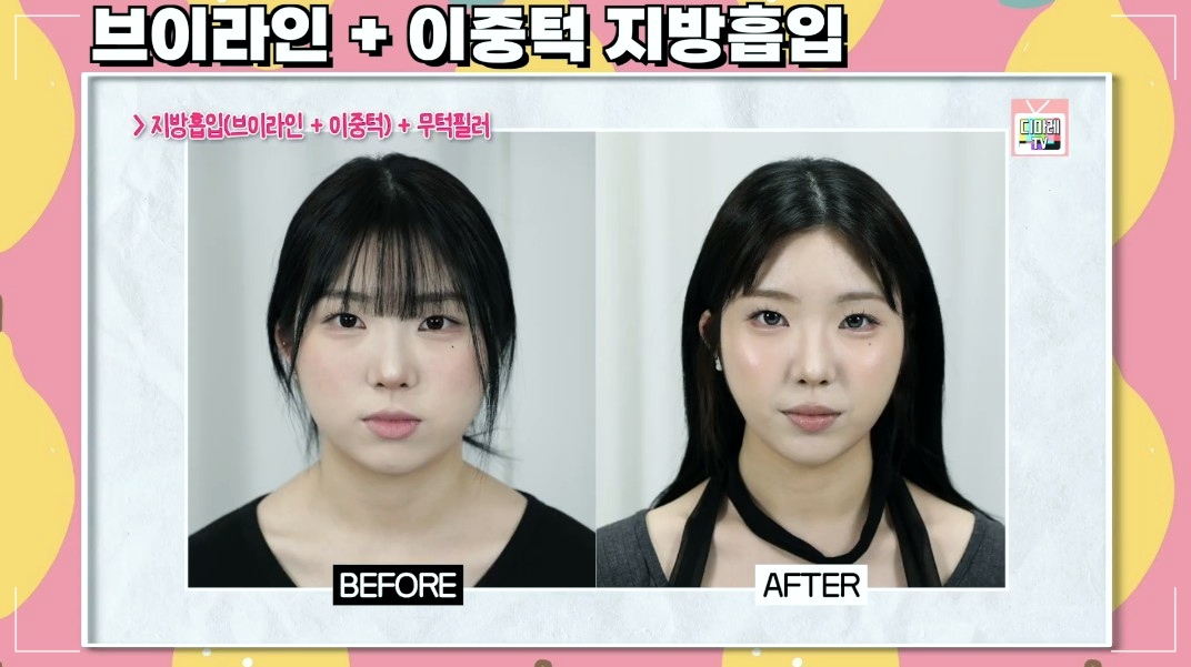 얼굴지방흡입 후기 디마레클리닉