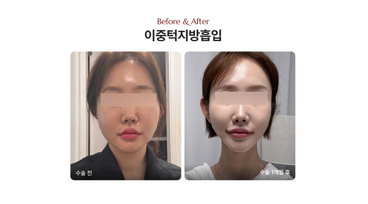 이중턱 지방흡입 효과 없음으로 재시술을 받으신 환자분의 전후사진