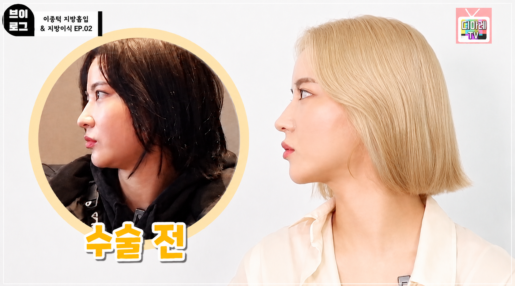 이마지방이식 치료 후 변화