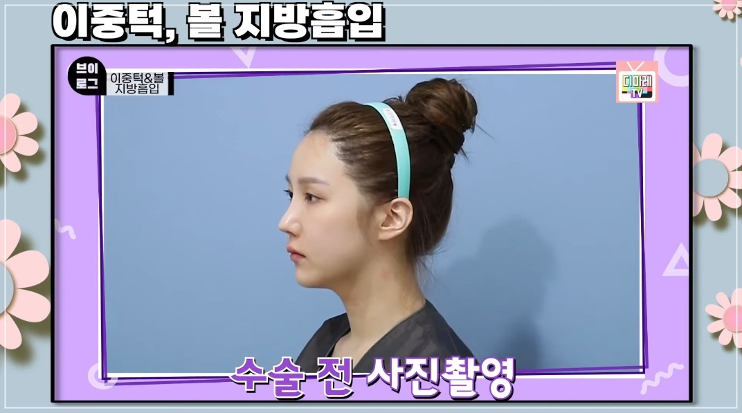 이중턱제거, 이중턱살제거, 이중턱살빼는방법, 디마레