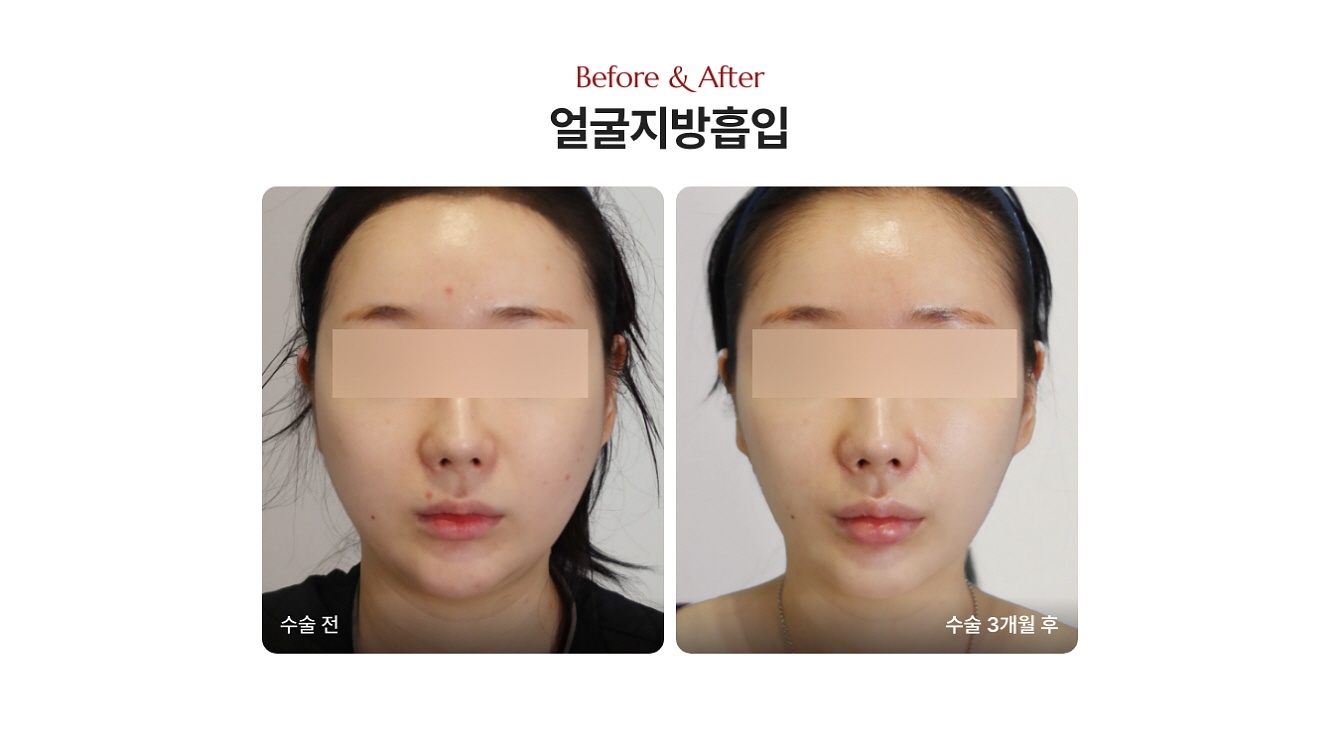 얼굴 살 안 빠지는 이유, 얼굴지방흡입 전후사진