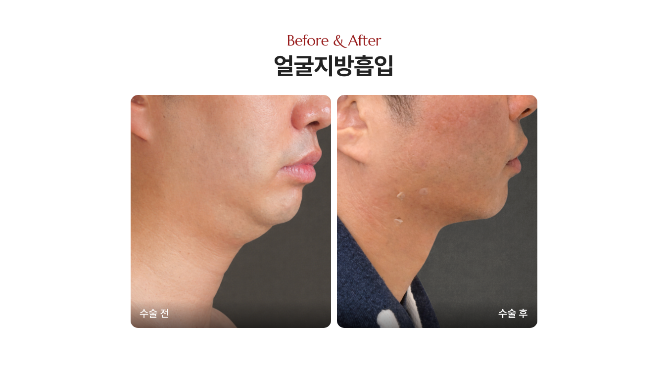 남자 턱지방흡입 가격, 디마레클리닉 전후사진