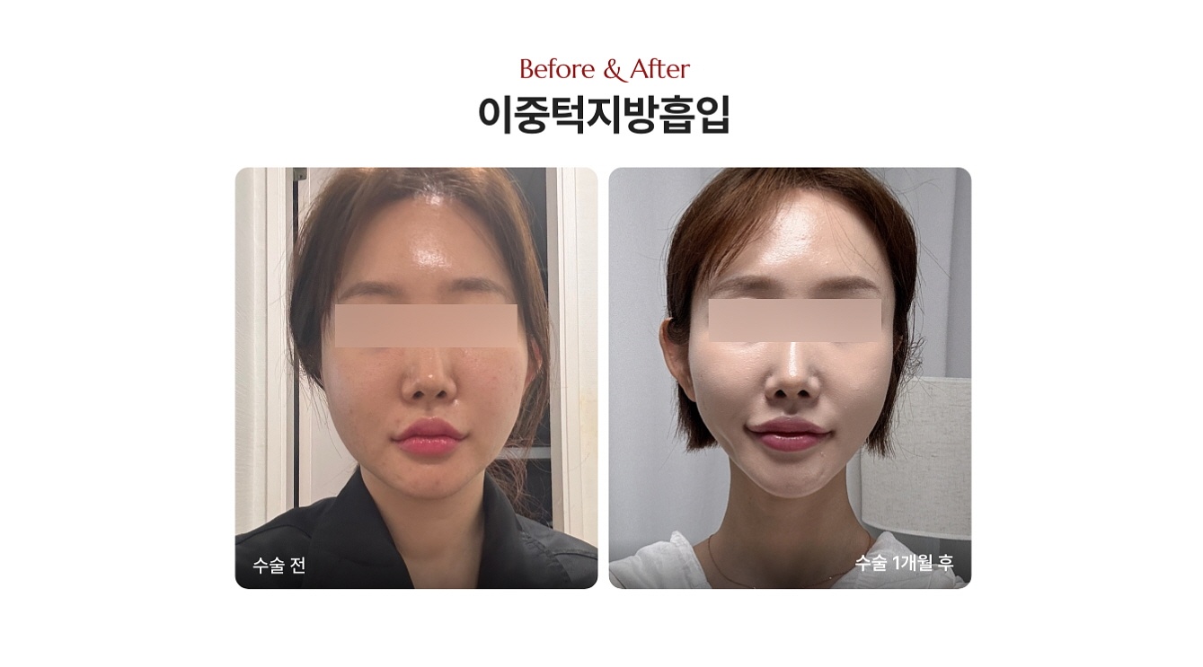 다이어트 얼굴살 이중턱 지방흡입 전후사진 (디마레클리닉)