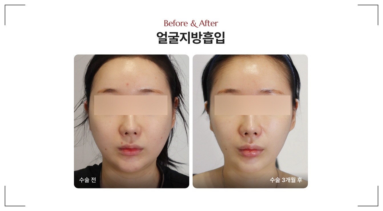옆광대 작아지는법 디마레클리닉 지방흡입 전후사진