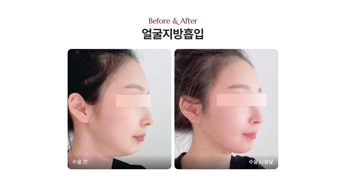 얼굴 작게 만들기 얼굴지방흡입 전후사진, 디마레클리닉