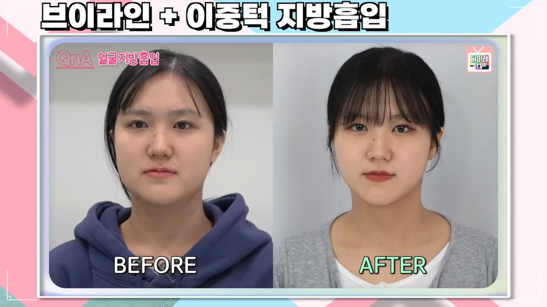 얼굴살만 안빠짐 얼굴지방흡입전후