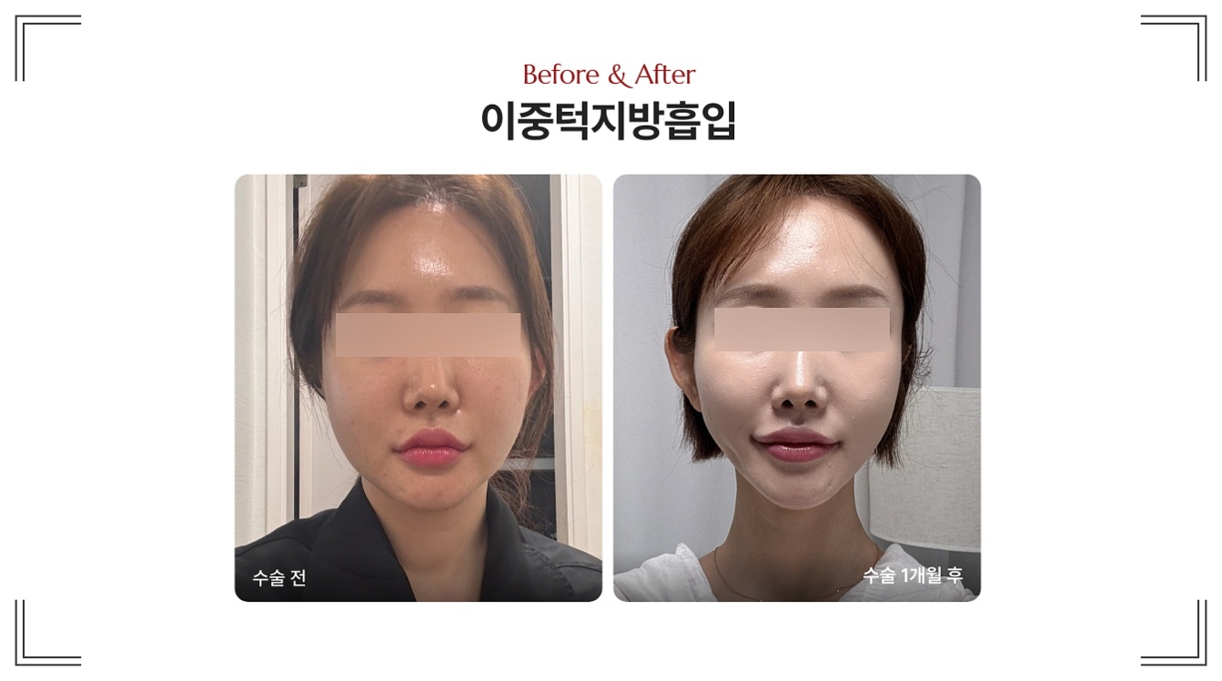 얼굴 처짐 시술 디마레클리닉 이중턱지방흡입 전후사진