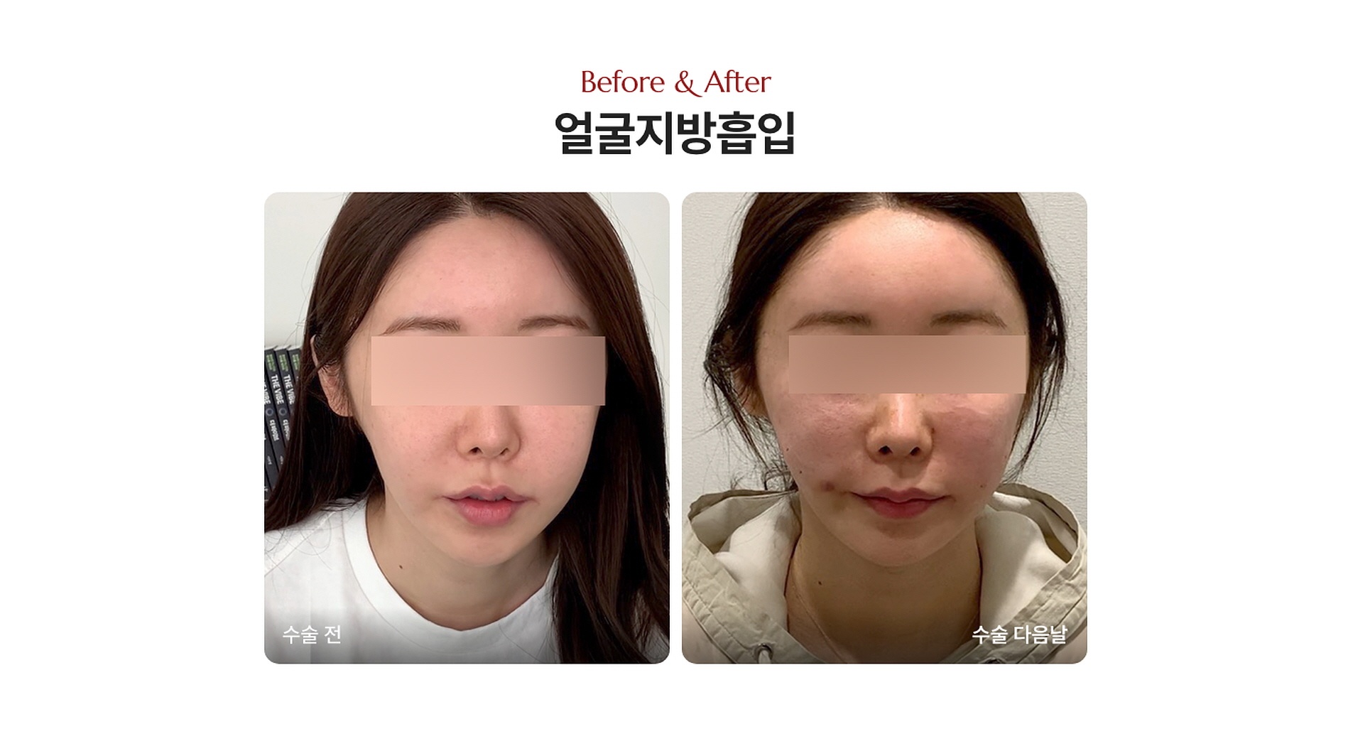 얼굴 살 빼는 시술 얼굴지방흡입 전후사진
