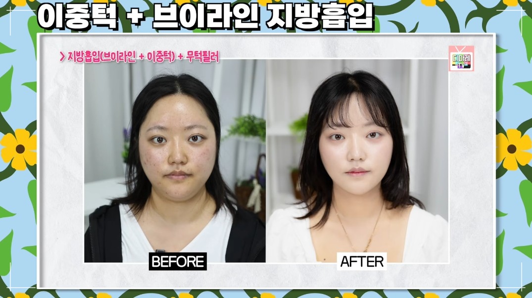 브이라인지방흡입 병원, 이중턱지방흡입 솔직 후기