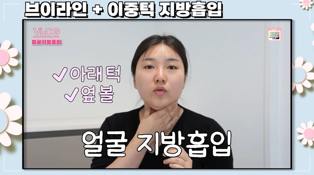 디마레_볼살지방흡입 잘하는곳