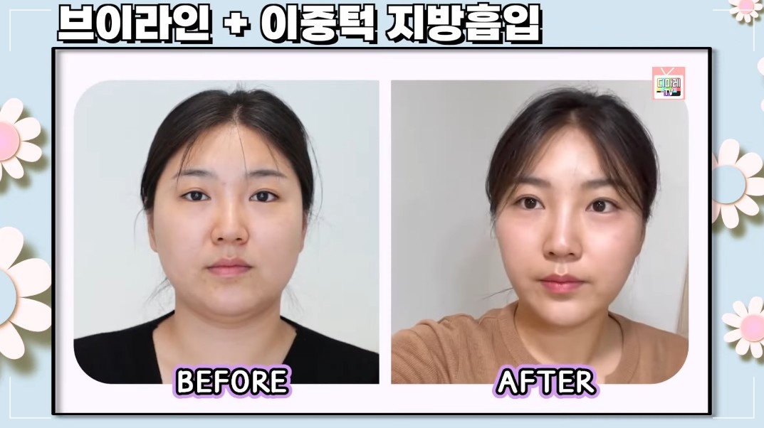디마레_볼살지방흡입 잘하는곳_1개월차후기