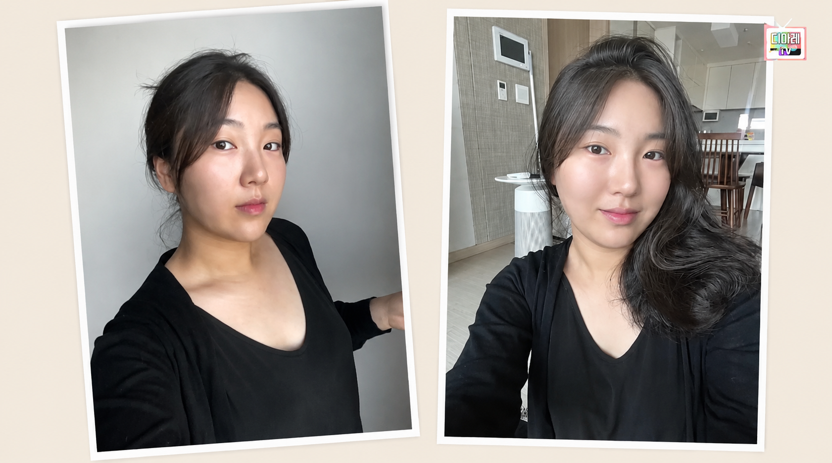 디마레_볼살지방흡입 잘하는곳, 주사, 리프팅 받아도 그대로였던 이유