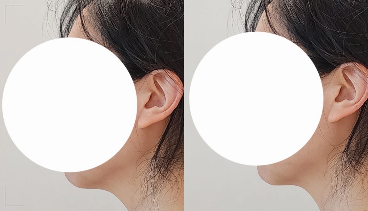 리프팅밴드 솔직 후기, 16년 경력 얼굴 구조 설계자 이하영 원장이 설계한 오마이페이스 사용 전후사진