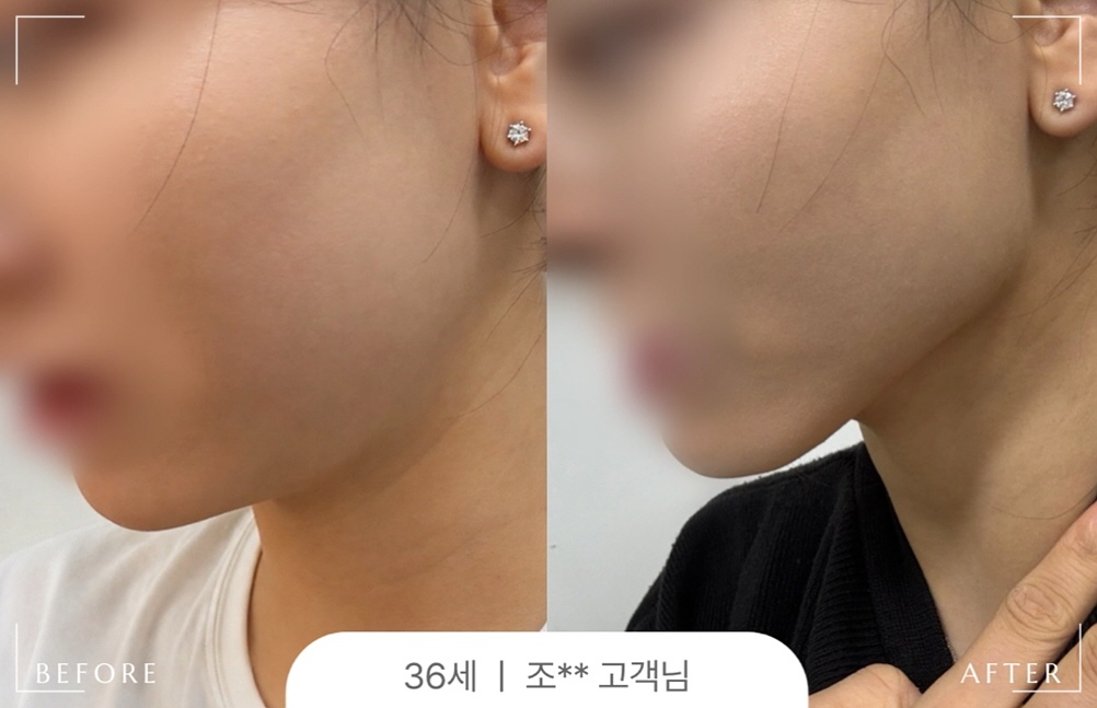 턱밑 살 생기는 이유, 오마이페이스 사용 전후사진
