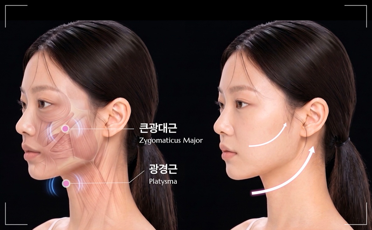 중안부 리프팅 운동, 듀얼 EMS 리프팅 밴드 오마이페이스가 큰광대근과 광경근을 리프팅하는 모습