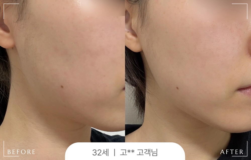 광대 리프팅 방법 듀얼 EMS 리프팅 밴드 오마이페이스 사용 전후 사진