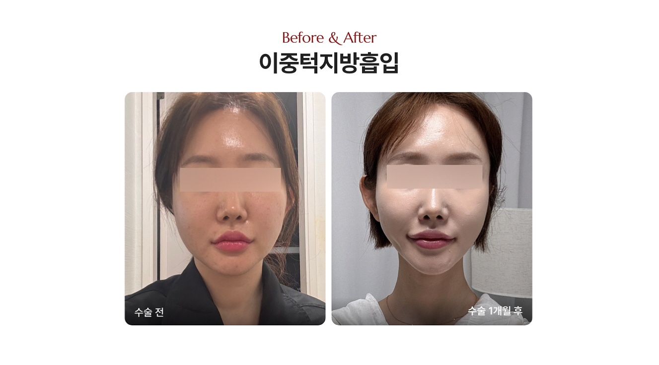 투턱 없애는법 얼굴지방흡입 잘하는곳 디마레클리닉 얼지흡 전후사진