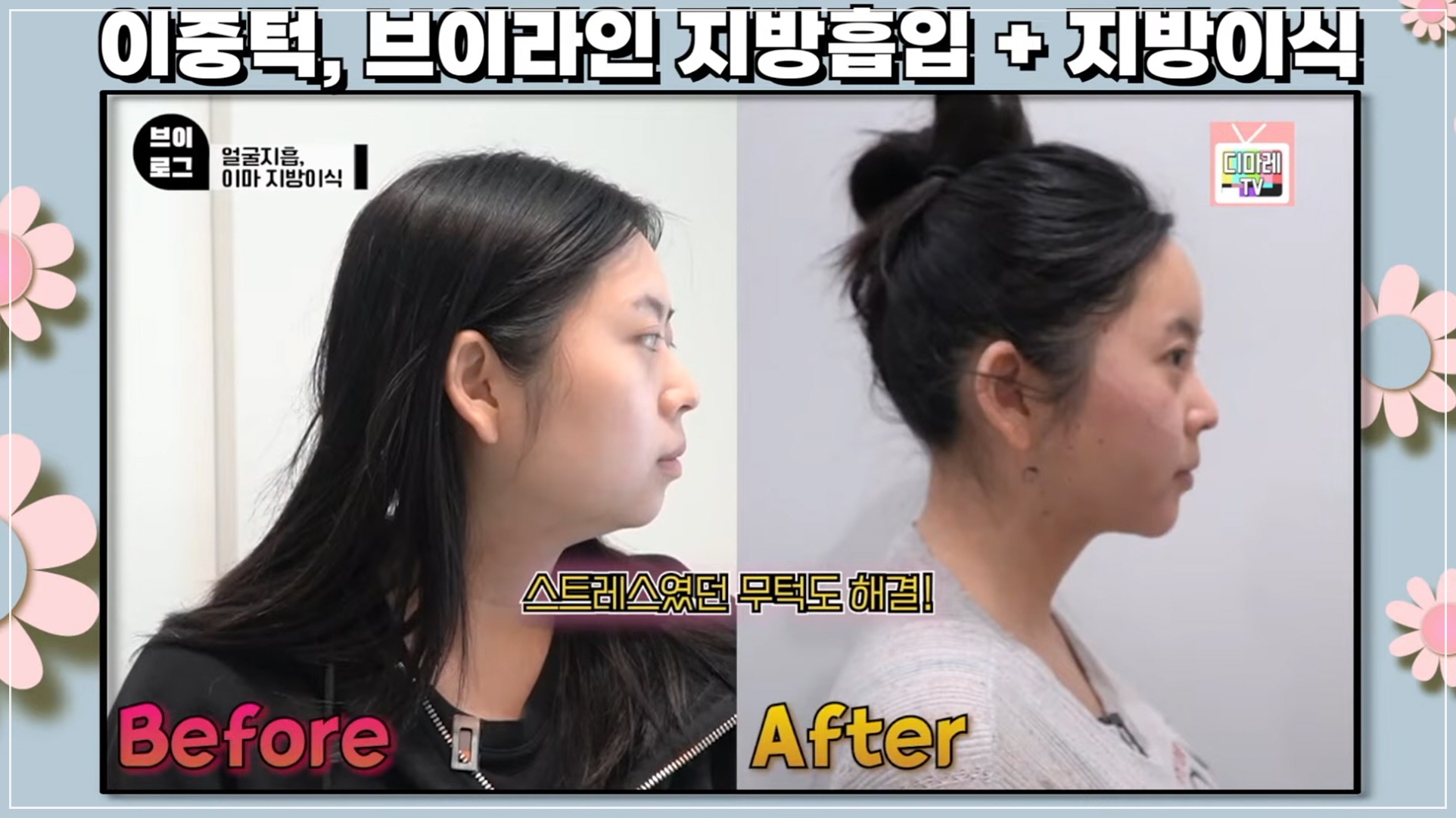 꺼진 이마 시술, 무턱 시술 추천 찾아보고 오신 환자분 시술 전후 모습