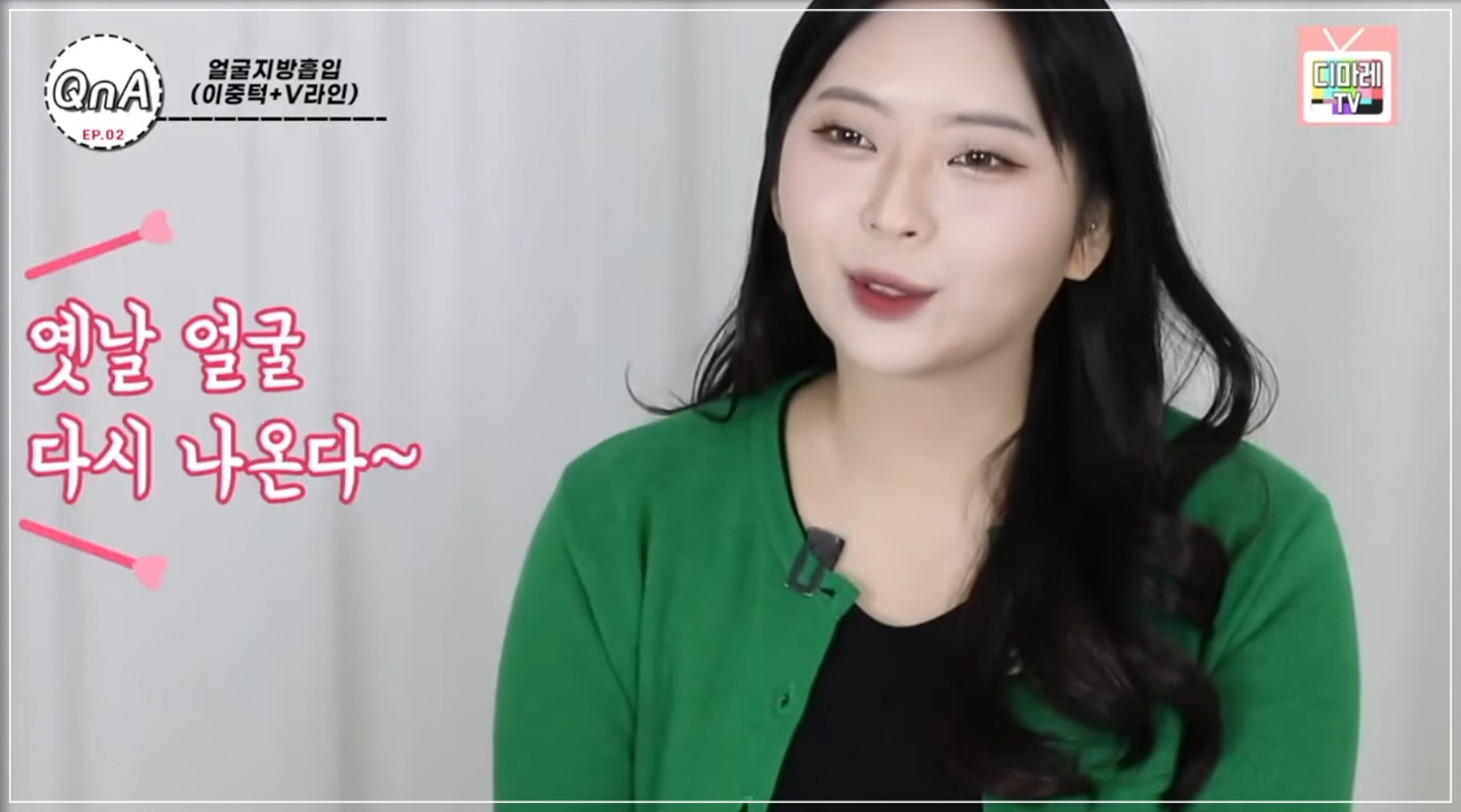 꺼진 이마 시술, 무턱 시술 추천 환자분 시술 3개월 후 모습