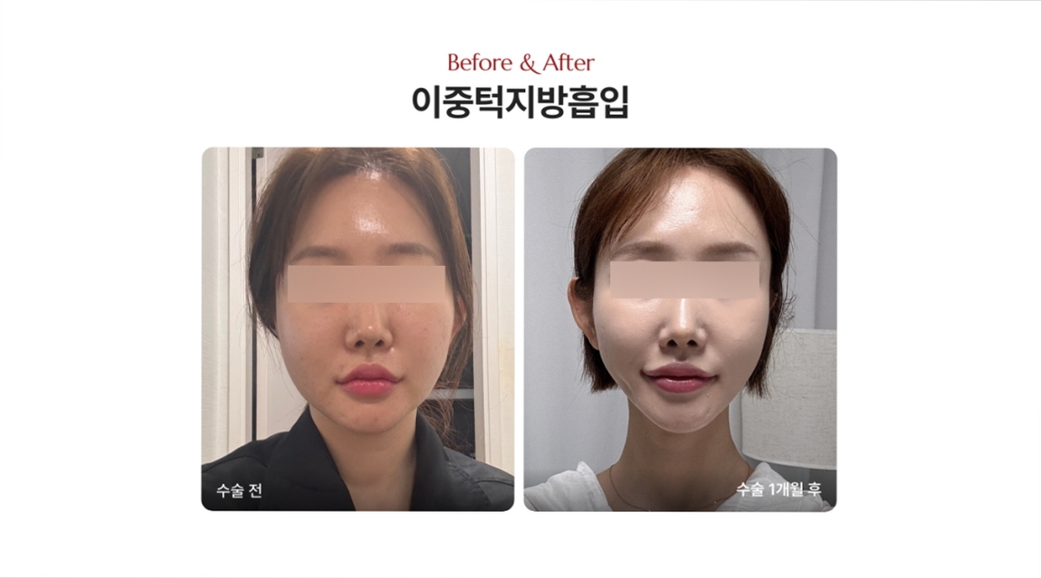 얼지흡 잘하는 병원 추천, 이중턱 고민이 있다면 꼭 확인해야 할 3가지