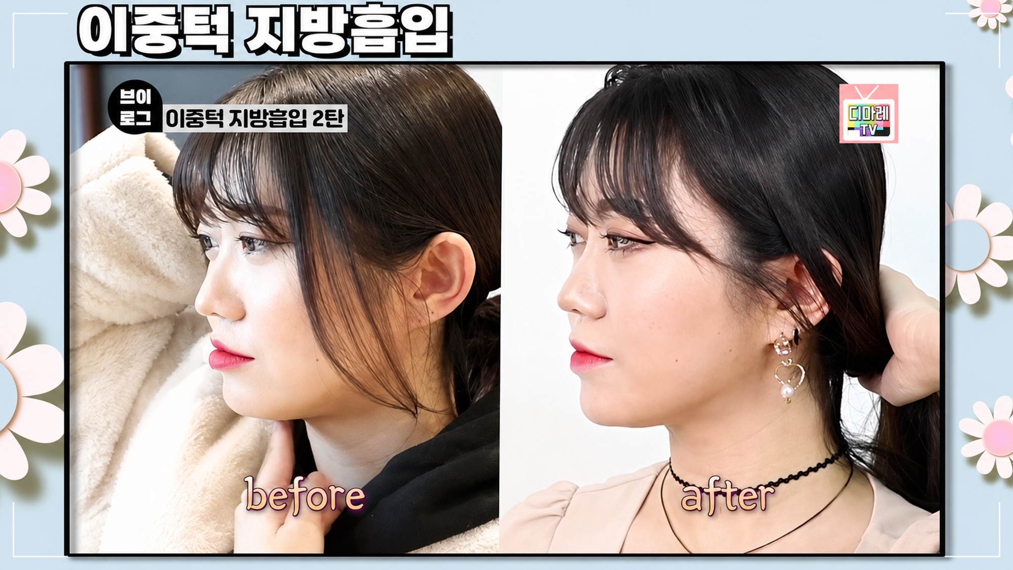 말랐는데 이중턱, 이중턱지방흡입 3개월 실제 후기 | 지방흡입 지방분해주사 차이_시술전후
