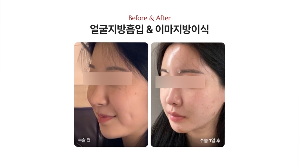 팔자주름 생기는 이유, 신논현 얼굴지방흡입이 필요한 경우는?_디마레 얼굴지방흡입