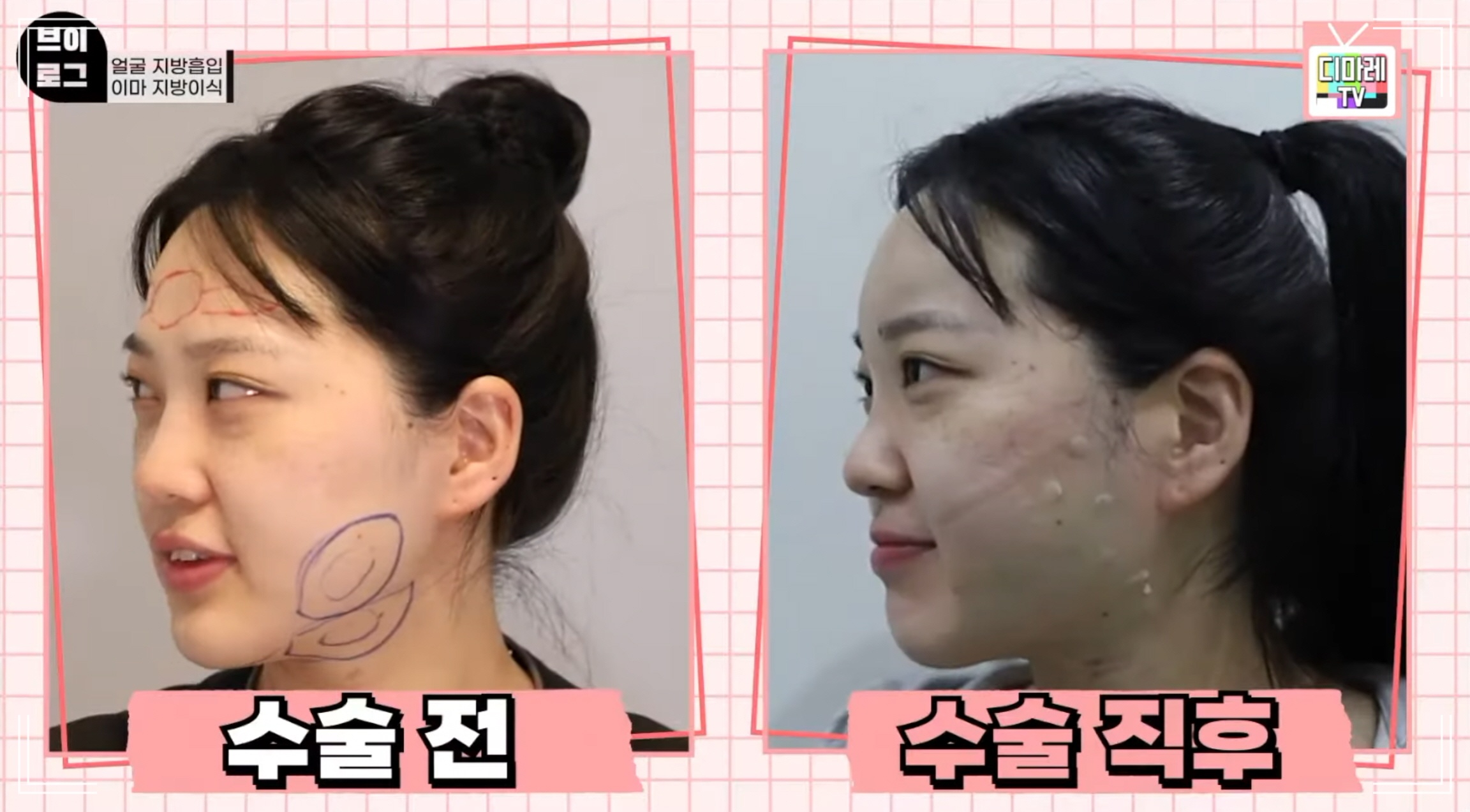 얼굴 작아지는 수술, 안면윤곽 볼처짐 걱정 없이 이중턱 개선한 전후사진
