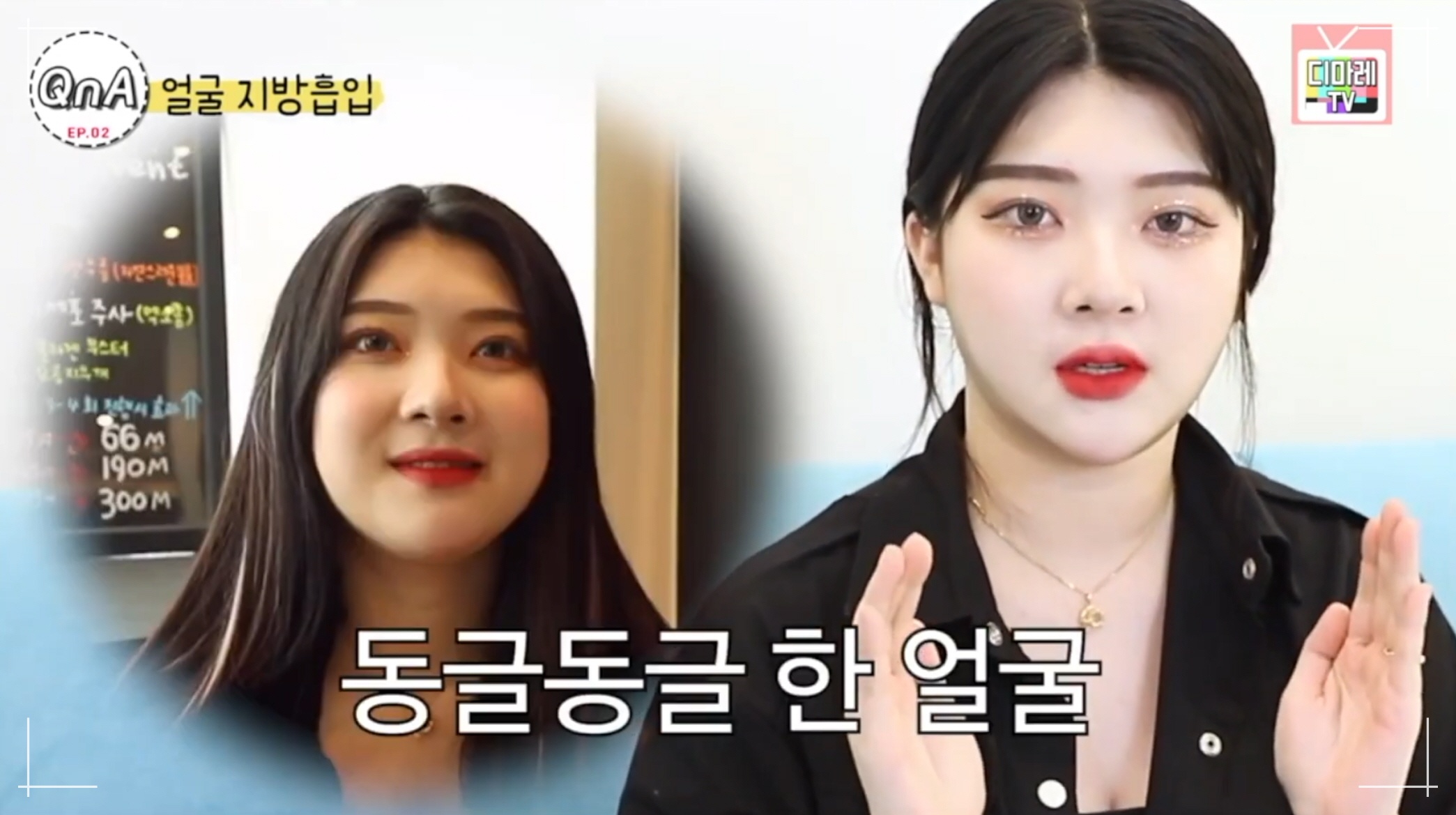 이중턱지방흡입 전후, 턱선 만드는법 상담받으셨던 고객분 디마레클리닉 수술 결정하신 동기
