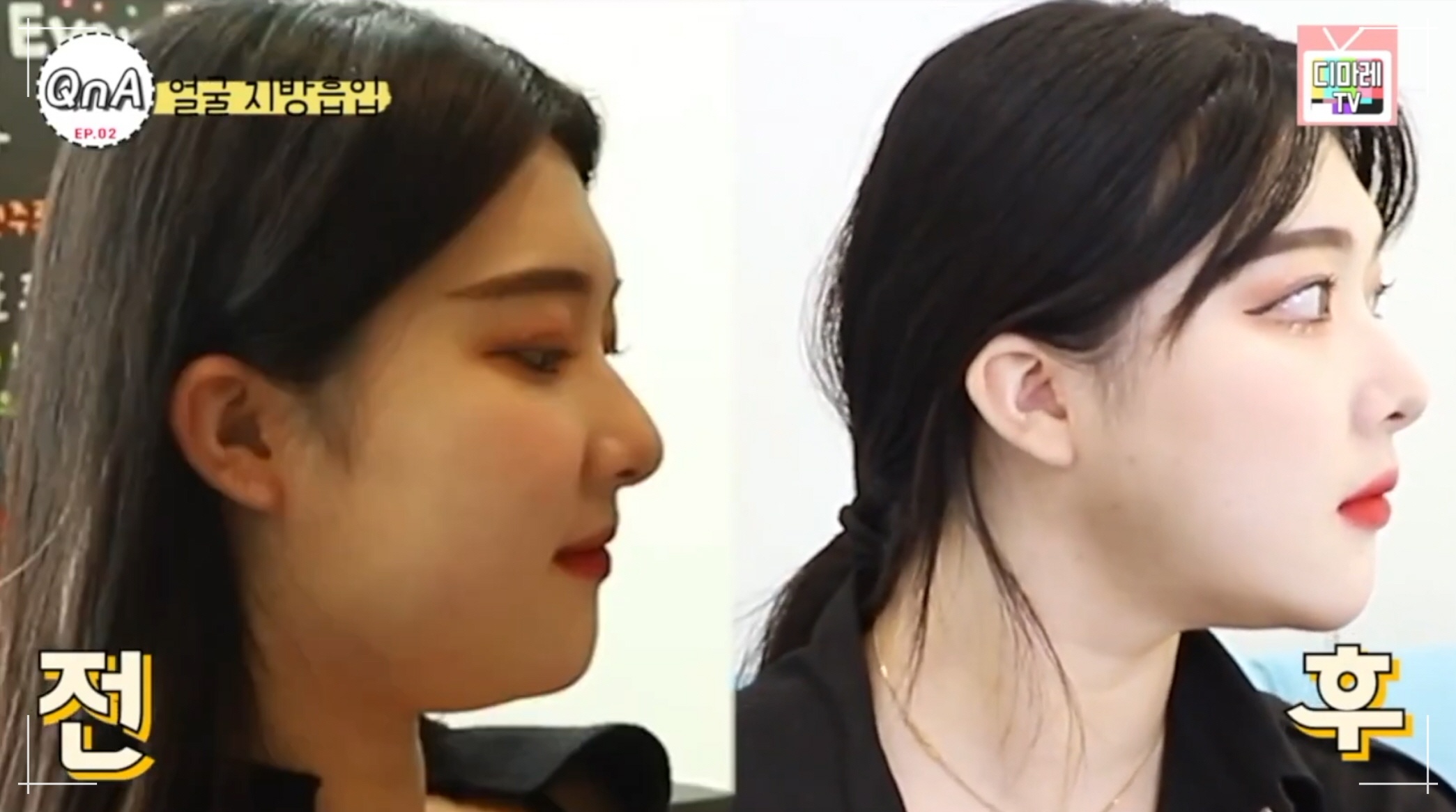 이중턱지방흡입 전후, 턱선 만드는법 디마레클리닉 얼굴지방흡입 3개월 후기 전후사진