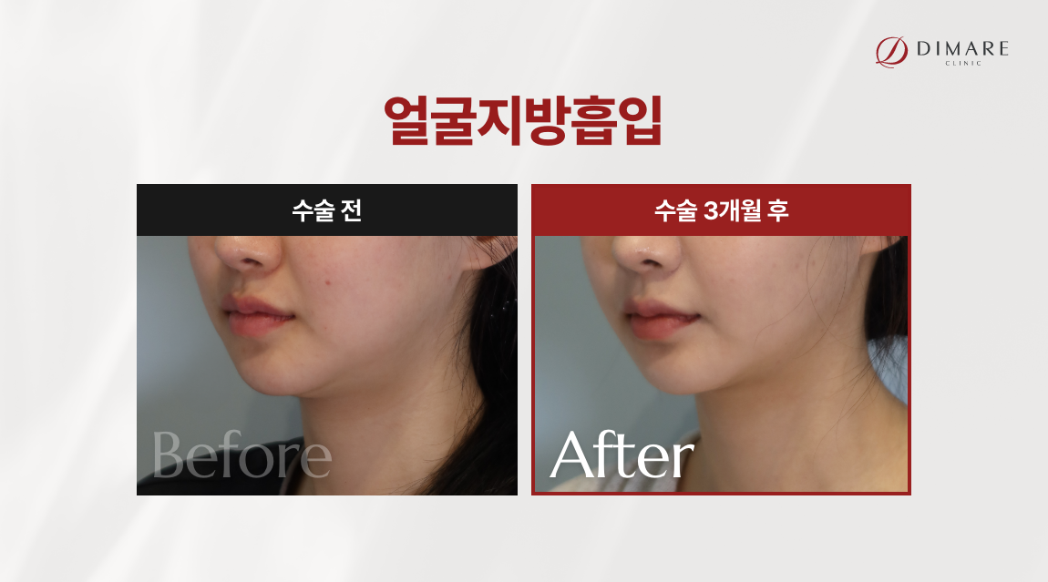 얼굴지방흡입 전후