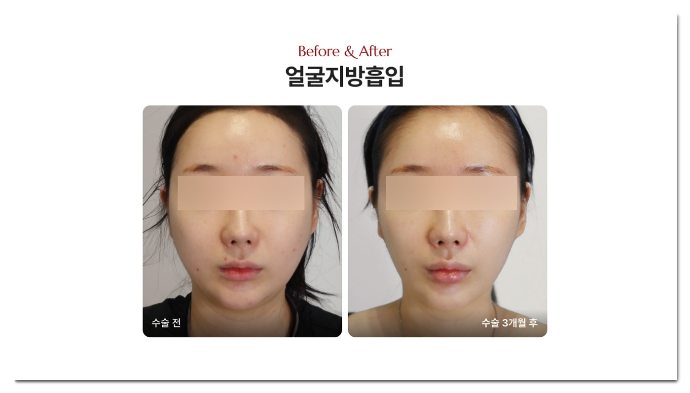 얼지흡 부작용 없는 성형 병원 디마레클리닉 얼굴지방흡입 전후사진