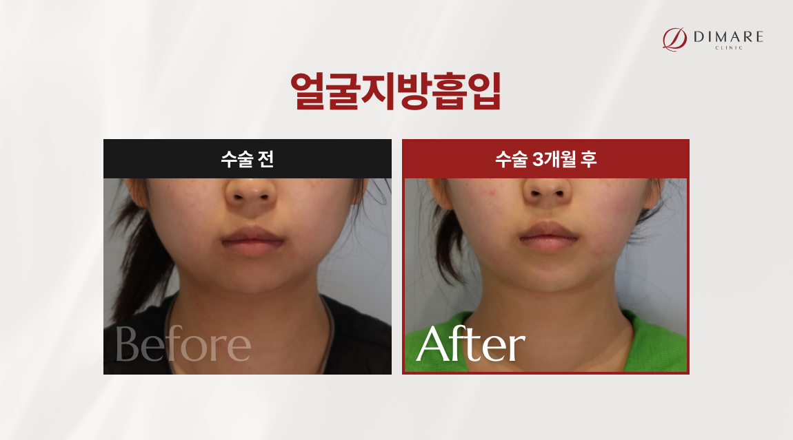 얼굴 작아지는 시술 (병원), 디마레