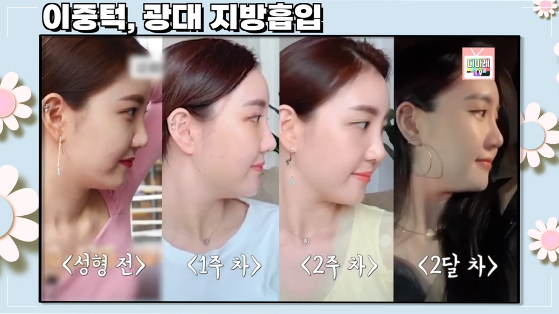 광대 지방흡입 후기 광대 밑 꺼짐 디마레클리닉