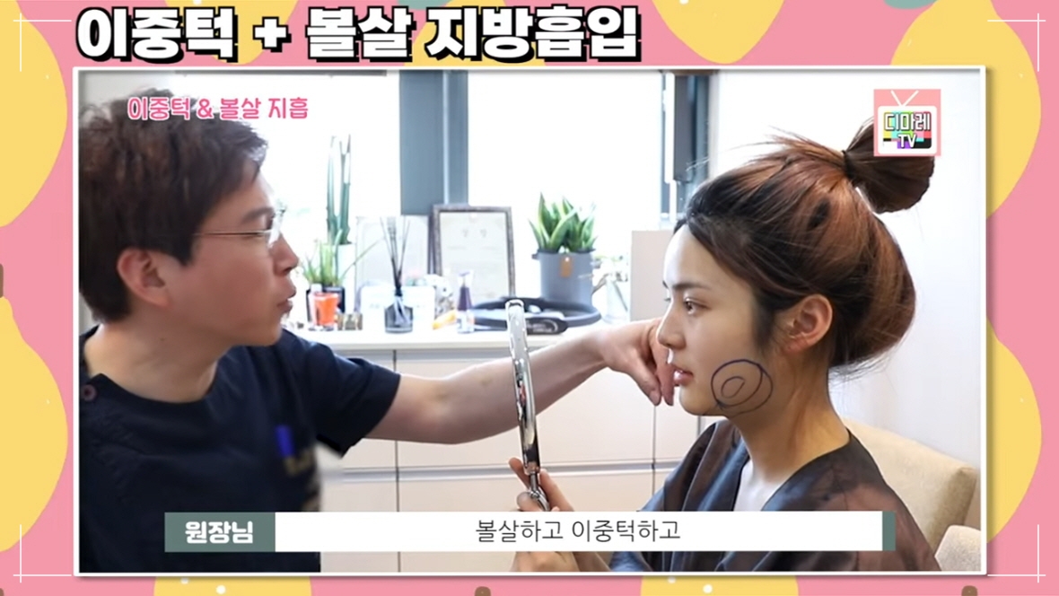볼살 제거 수술 얼굴지방흡입 진행