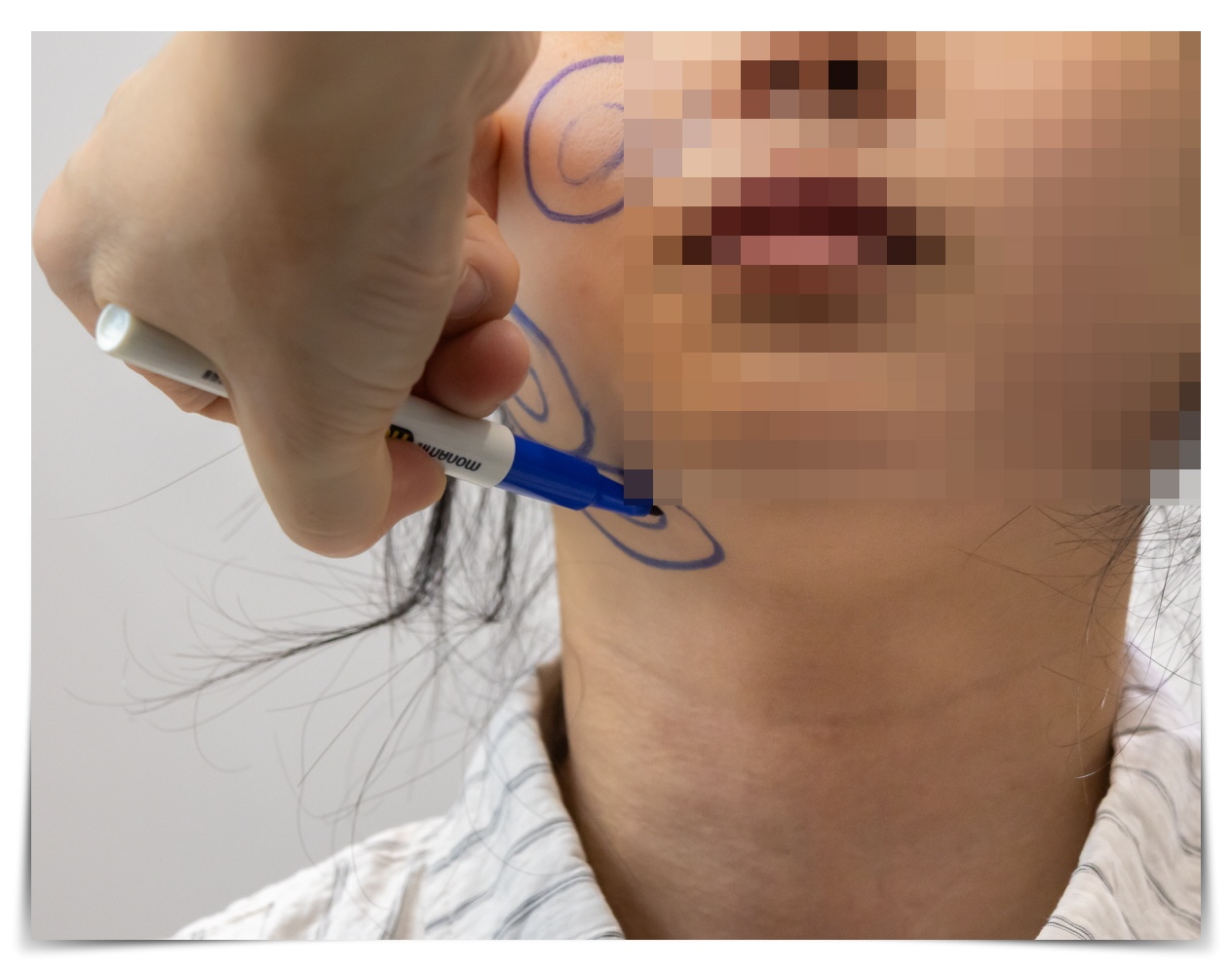 얼굴 지방흡입 프로세스