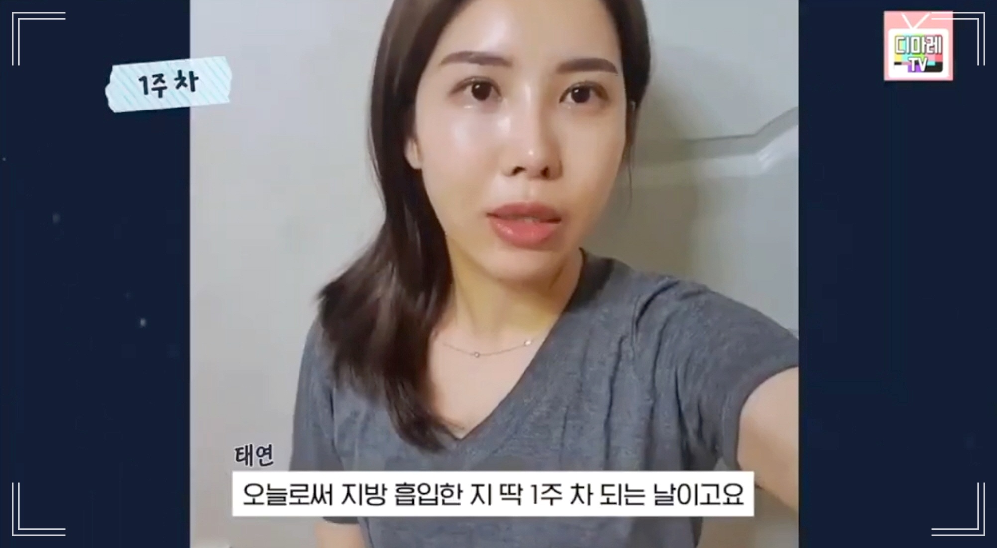 이중턱 제거 병원 디마레클리닉에서 턱 지방흡입 후회 없이 받으신 분 1주 후기