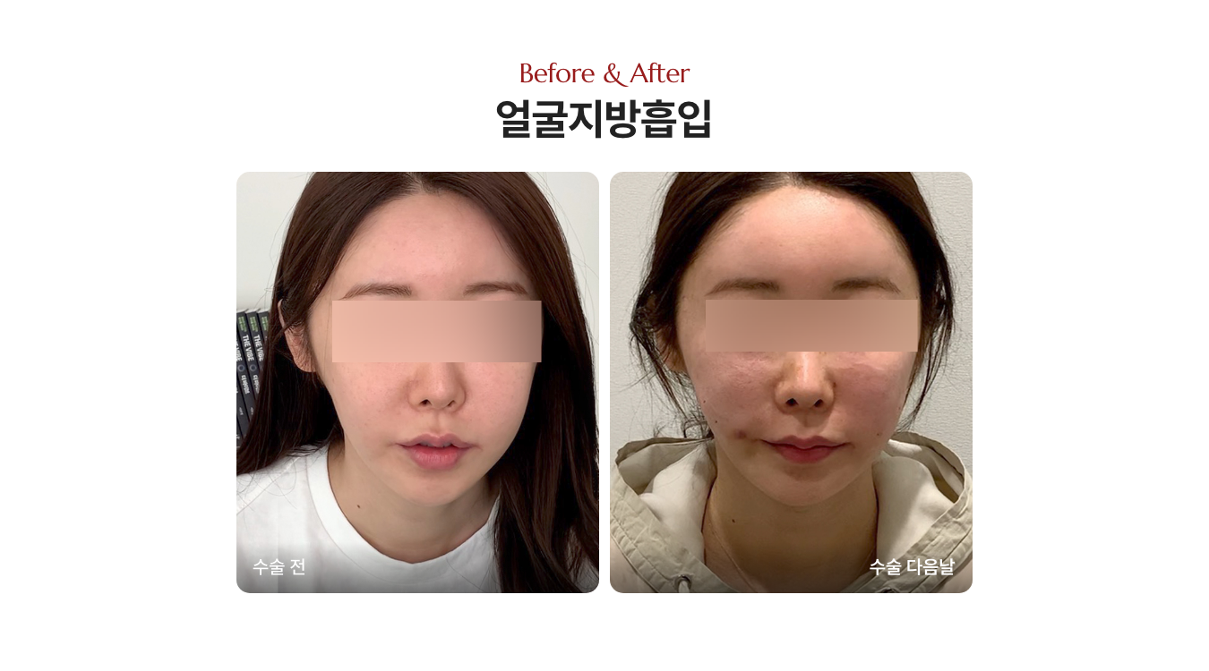 디마레클리닉 지방흡입수술 전후 비교