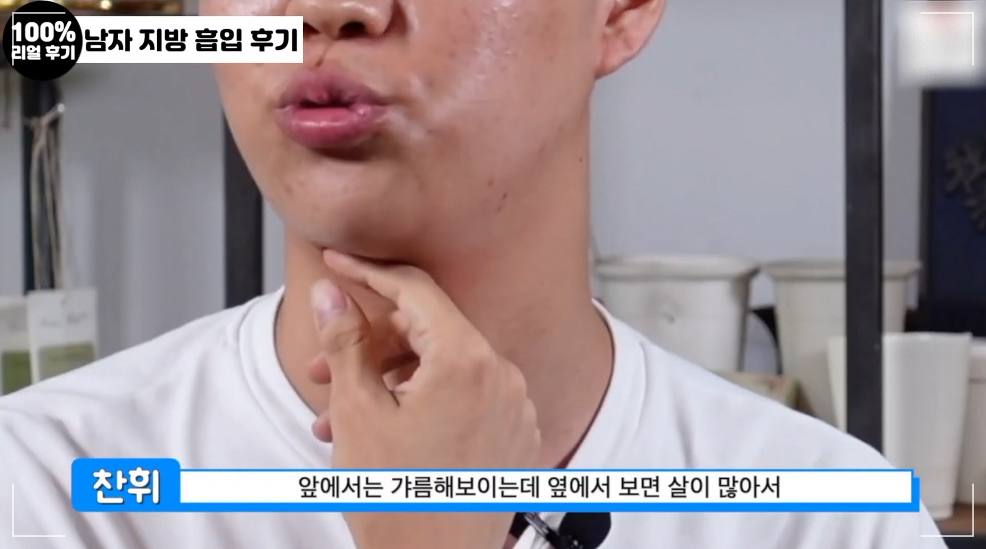 남자 얼굴 작아지는법, 디마레클리닉 이중턱 지방흡입 환자분의 고민
