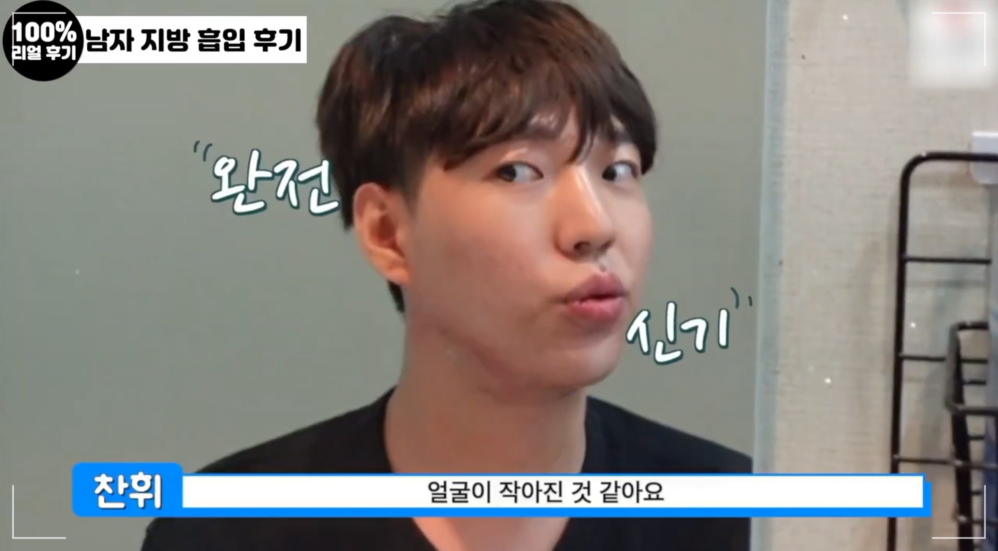 남자 얼굴 작아지는법, 디마레클리닉 이중턱 지방흡입 환자분의 시술 후 사진