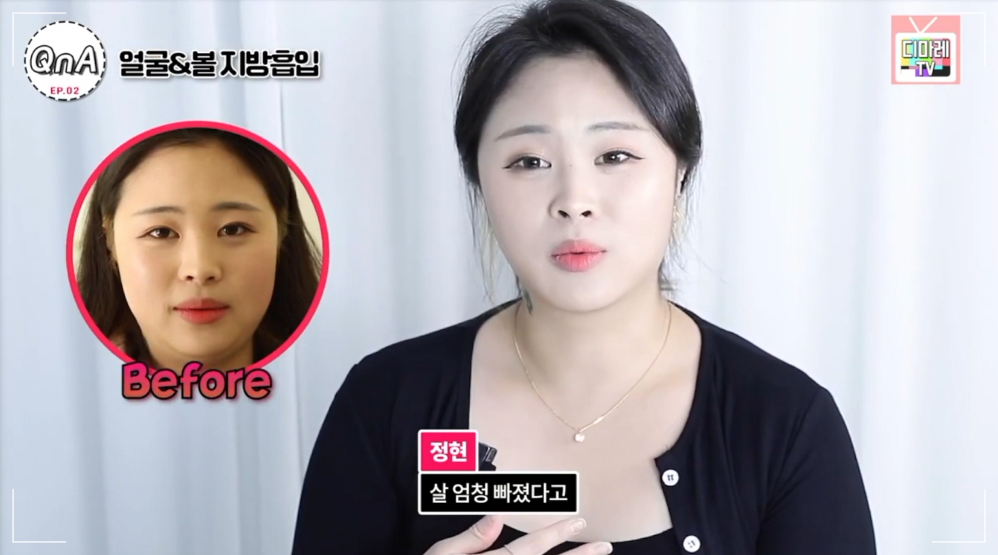심술보 제거로 매끄러운 얼굴라인 정리한 환자분의 디마레클리닉 인터뷰 사진