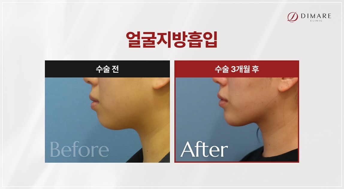 이중턱 없애기, 피부 처짐 고려한 지방흡입 디마레클리닉 시술전후 사진