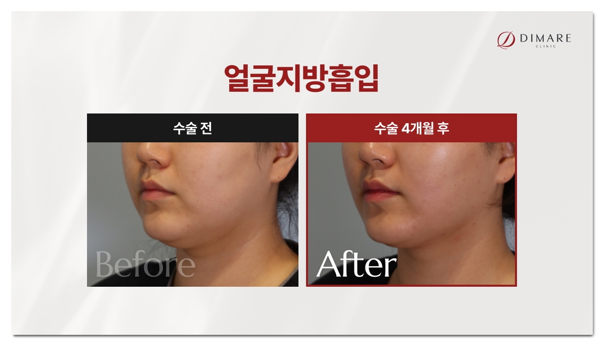 중안부 짧아지는 수술, 디마레클리닉